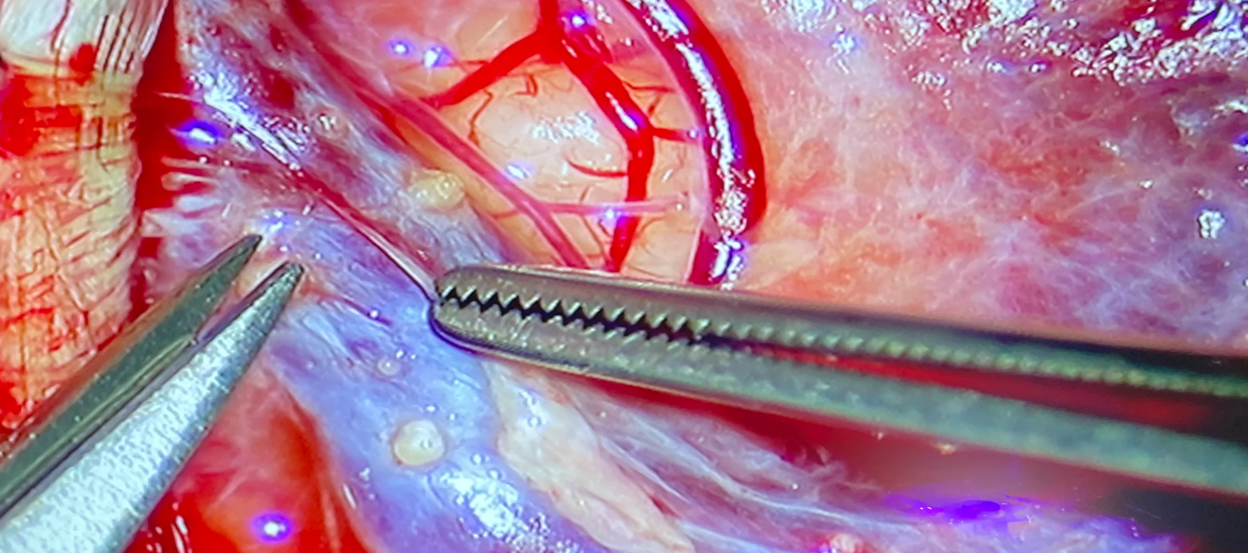 cerbo clinic microsurgery brain