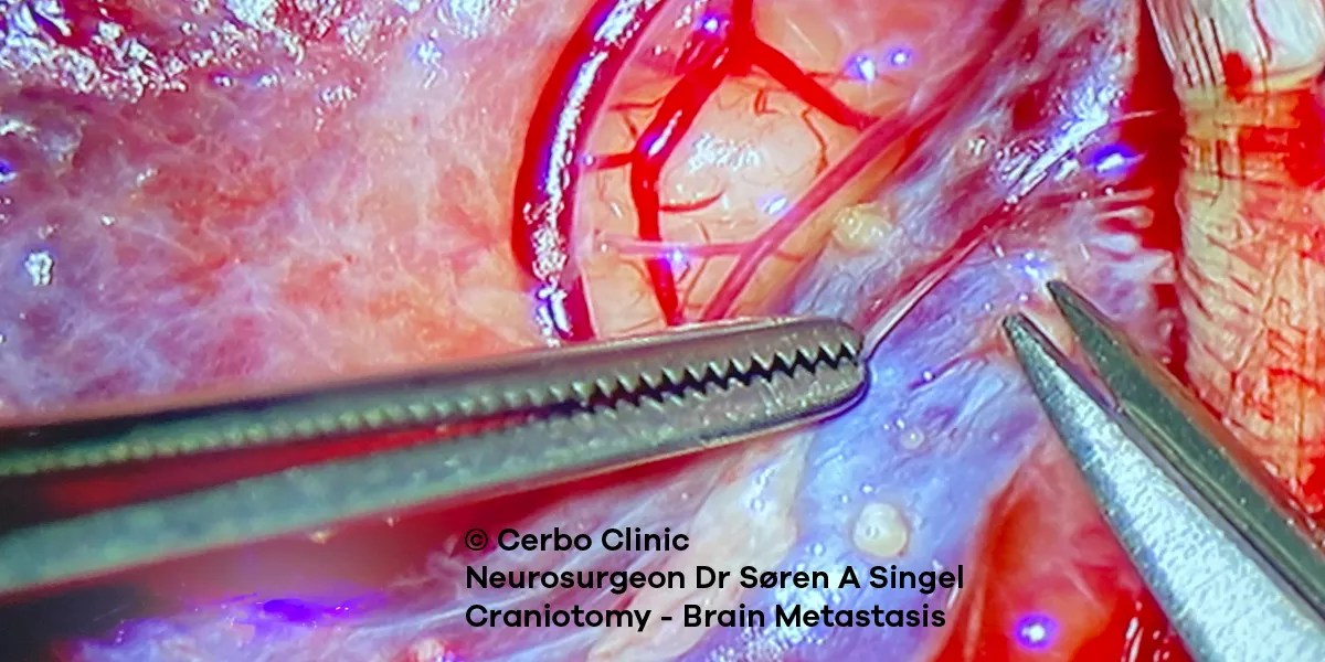 Søren Singel MD - neurosurgeon removing brain metastasis by cranial microsurgery