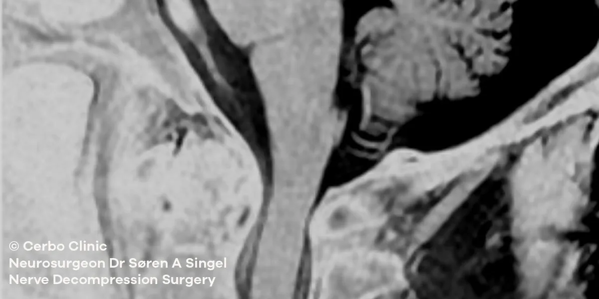 Dr Søren A Singel - neurosurgeon - nerve surgery - microdecompression of cranial nerve